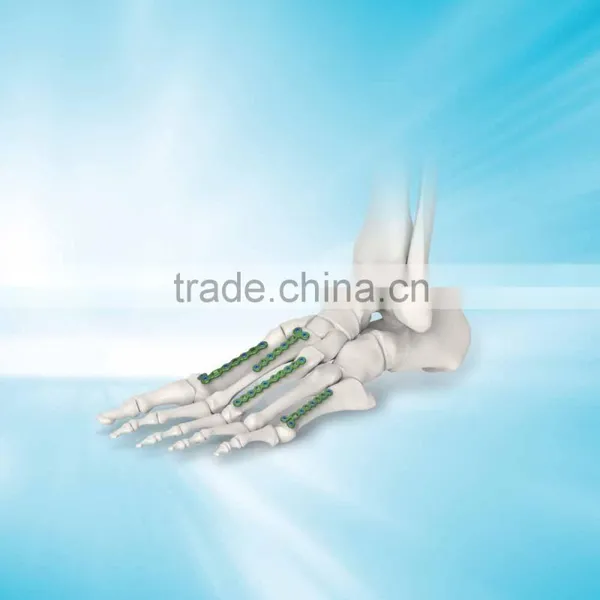 Customized Anterolateral Locking Plate System,lcp Locking Plate,2.5 Talus Locking Plate