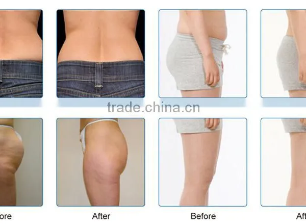 Body Slimming Coolplas Criolipolysis Weight Loss Fat Freezing Anti Cellulite Body Slimming Machine Body Massager Machine photo-3
