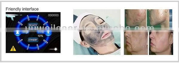 Telangiectasis Treatment YUWEI-Q Switch ND YAG Laser 1064nm 532nm Tattoo Removal Laser Machine Q Switch Laser Tattoo Removal Machine photo-6