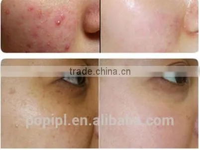 High Quality and Best Price Fractional C02 Laser Machine RF Excited Portable Design Fractional Producers Acne Treatment photo-2