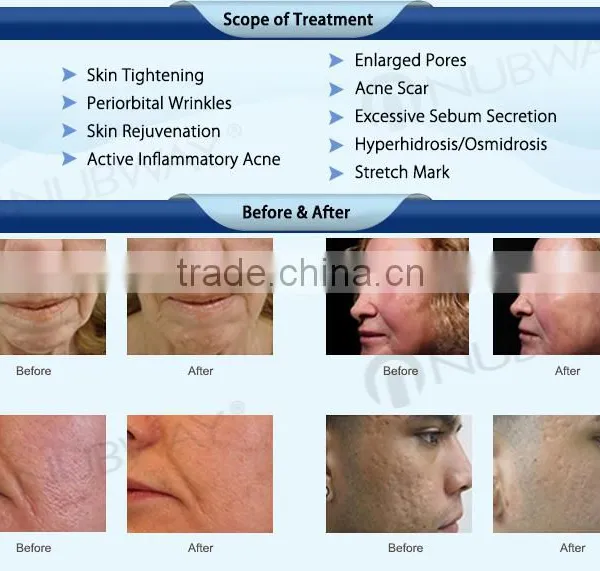 Best Laser Fractional Scarlet&wrinkle Removal&skin Rejuvenation Device photo-4