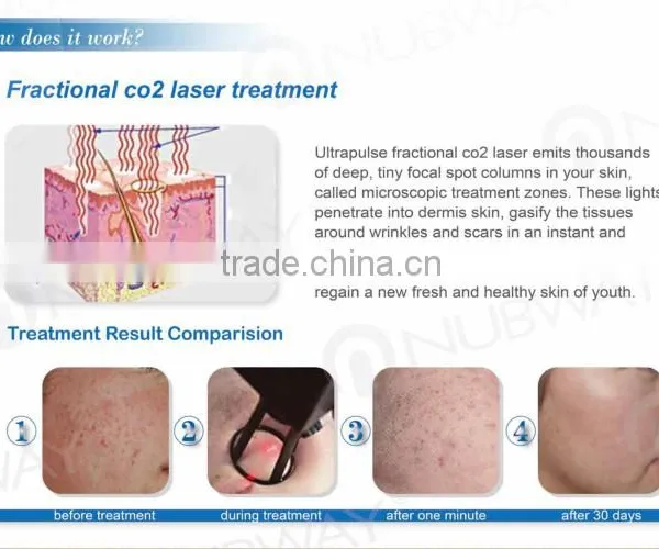 2016 Lowest Distributor Price: Super Pulse Co2 Laser for Skin Refreshing Scar Remov for Acne Scars Treatment , Burn Debridement photo-5
