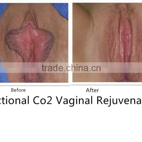 60w (CE Certificate) USA RF Tube CO2 Fractional Laser Vaginal Tightening/Fractional CO2 Laser photo-4