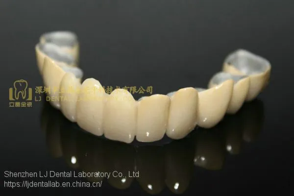 Dental Crown Porcelain Fused Metal, PFM, VMK, Dental Prostheses, Laboratoire Dentaire, Dentallabor, Laboratorio Dental, Dental Laboratory, Shenzhen LJ Dental Lab China photo-2