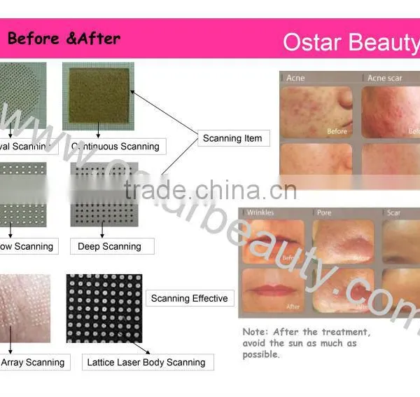 Medical Co2 Laser Machine for Scar Removal photo-3
