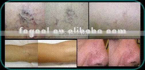 2015 High Quality Professional 980nm Diode Laser for One-time Remove Rosacea photo-6