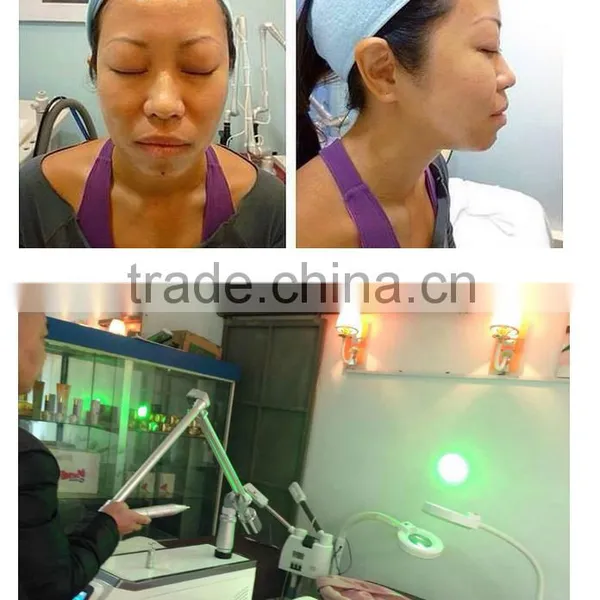Retailer Wanted CE Approved Q Switch Brown Age Spots Removal Nd Yag Laser Machine For Tattoo Removal 532nm photo-6