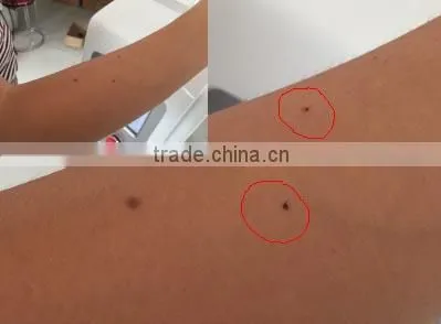 2016 New Product Co2 Laser Scar Removal Cost / Fractional Co2 Laser photo-6