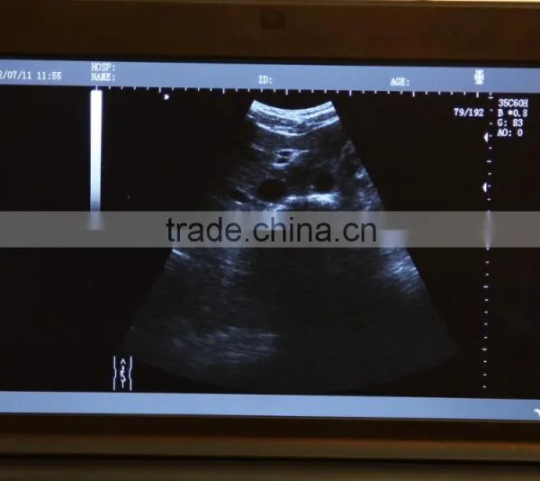 Lower Price Mini Laptop Medical Diagnose Ultrasound Scanner Machine-abdominal, Cardiac, Obstetrics, Gynecology photo-5