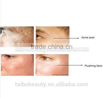 Radio Frequency RF Wrinkle Removal Machine Stretch Mark/best Skin Rejuvenation/ Skin Lifting Radio Frequency photo-6