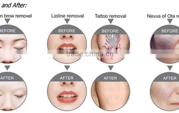 SUS Fda Approved Tattoo Removal Lasers nd Yag Laser Tattoo Removal photo-5