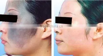 532nm China Produced Q Switch Nd Yag Laser Machine With 1064nm And 532nm And Black Doll Head 800mj photo-6