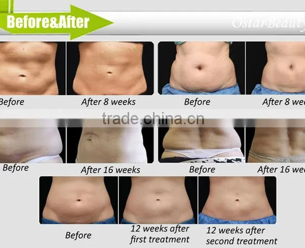 Hot Sale Freezing Fat Slimming Machine Medical photo-6