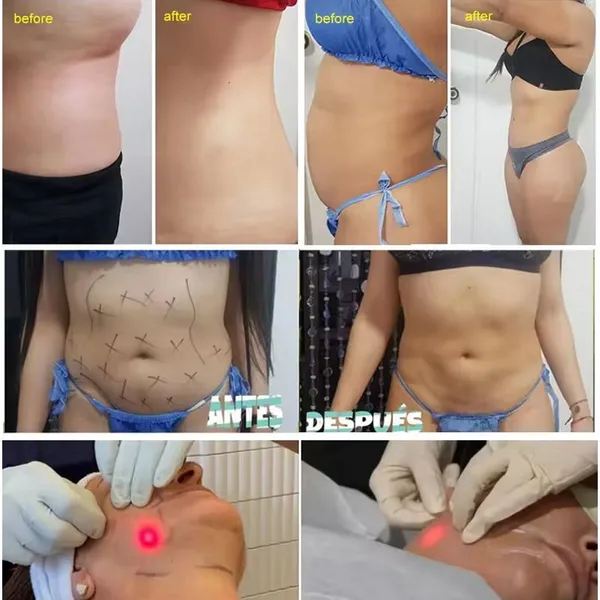 Durable Stainless Steel Laser Hair Removal Machine With Medical-Grade Materials photo-4