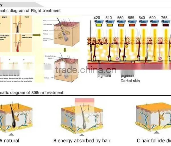 Safe and Good Effect Personal Hair Removal Machine for Sale photo-3