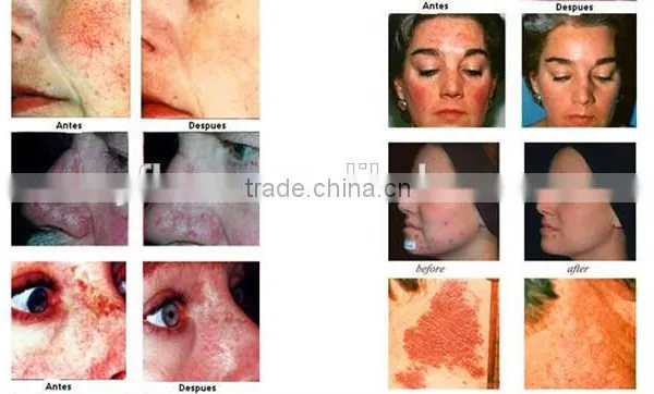 Salon Use PDT LED 7 Color for Skin Care / PDT Beauty Equipment / PDT Machine photo-6
