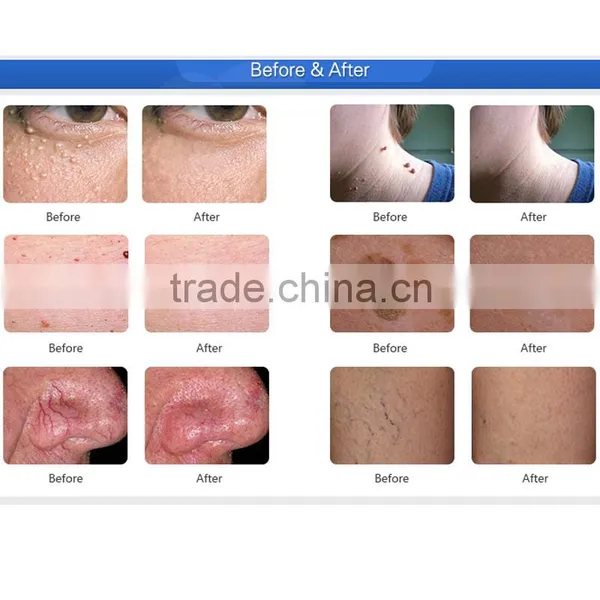 30MHz RBS Pigmentation Spider Vein Vascular Removal Skin Tag Removal Device photo-6