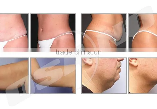 Lipolysis 650nm Lipo Diode Laser Slimming Machine With 12 Laser Pads photo-6