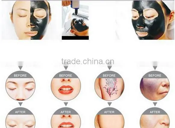 Beautiful nd Laser Tattoo Removal Beauty Equipment photo-5