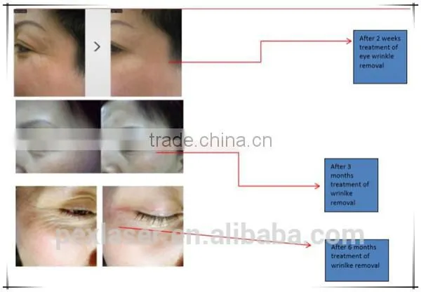 Eye Wrinkle Treatment RF Eye Lift Machine photo-6