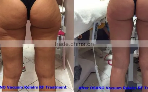 Professional Anti Cellulite Therapy Vacuum Roller Cellulite Machine photo-6