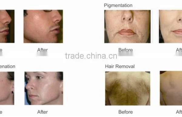 Med.apolo HS-665 Elight(IPL + RF) Laser Hair Removal Beauty Machine photo-4