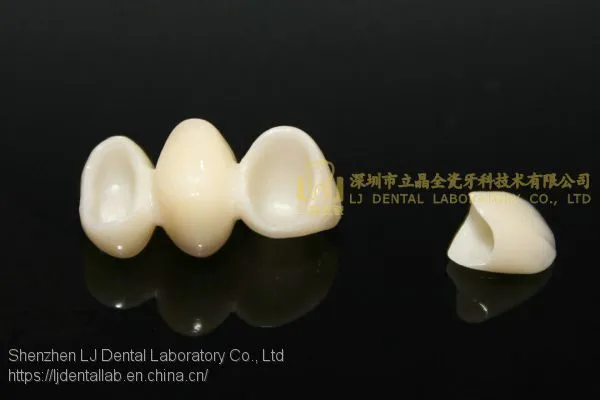 Dental Crown E.Max Ceramic, Porcelain Crown, Dental Veneers, Laboratoire Dentaire, Dentallabor, Laboratorio Dental, Dental Laboratory, Shenzhen LJ Dental Lab China photo-5
