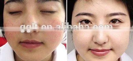 Good Effects Wholesale Vascular Remover 980nm Spider Vein Removal Machine photo-5