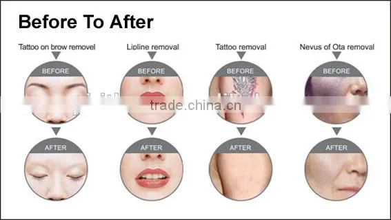 2016 Medical CE Approved Ipl, Ipl Home Laser Pigmentation, Home Ipl photo-3