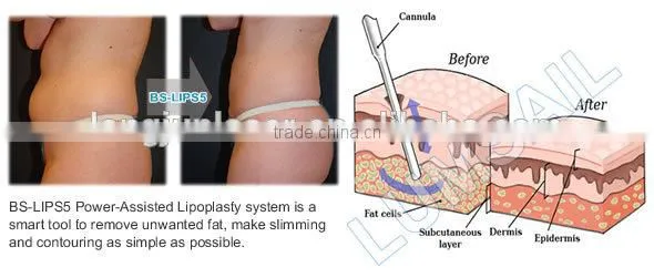 Surgical Liposuction Machine PAL Liposuction photo-5