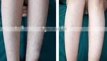 530-1200nm 2016 Best Ipl Photofacial Machine For Medical Home/portable Ipl Hair Removal Machine No Pain photo-6