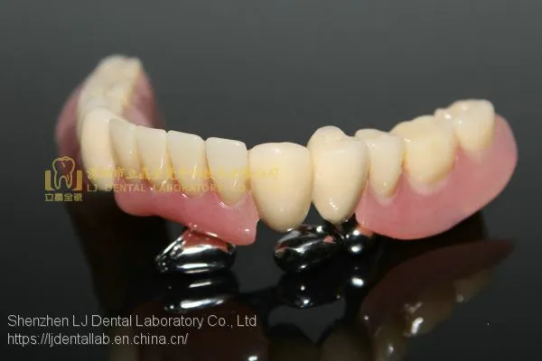Dental Telescope Denture, Telesope Crown, Dental Prosthesis, Laboratoire Dentaire, Dentallabor, Laboratorio Dental, Dental Laboratory, Shenzhen LJ Dental Lab China