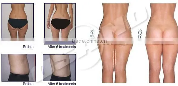 Liposuction Ultrasonic Cavitation Fat Dissolving Machine photo-6