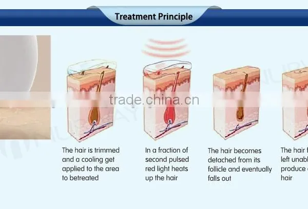 Back / Whisker 2017 Soprano Diode 1-800ms Laser Skin Hair Removal AC220V/110V Pain-Free photo-6