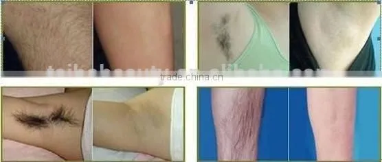 Factory Offer Medical Equipment Laser Therapy for Hair Removal, 808nm Diode Laser Beauty Equipment photo-6