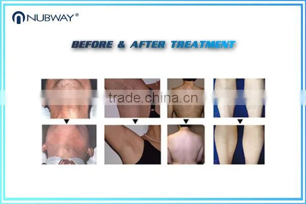 Popular!!! Guarantee 20 Million Flashes Spa Use 808nm Diode Laser Machine for Hair Removal photo-4