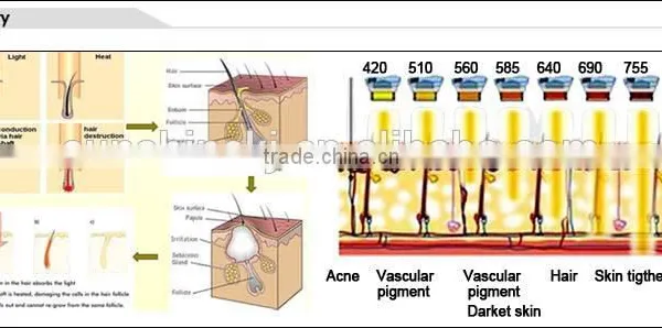 Ipl Hair Removal for Blond Red and Grey Hair photo-3