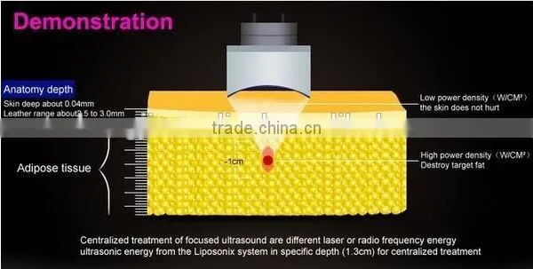 Liposonix Weight Loss Slimming Machine for Beauty Salon Use photo-5