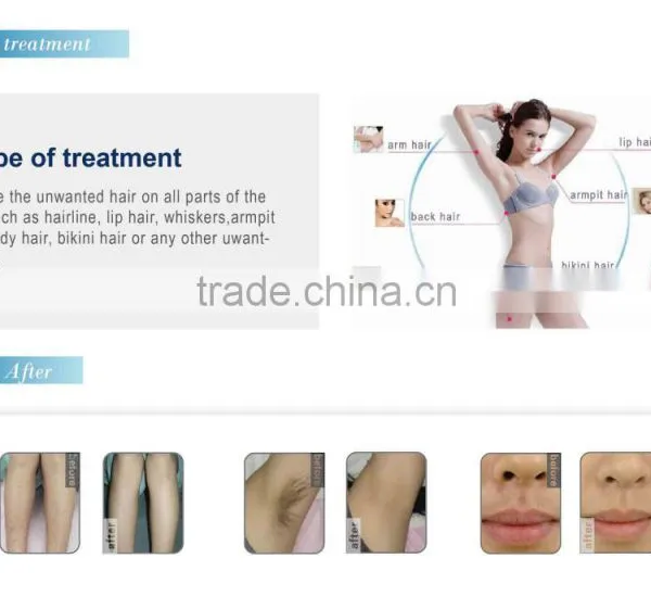 1-10HZ Newest 808nm Diode Laser Face Hair Removal Machine/810nm Portable Laser photo-4