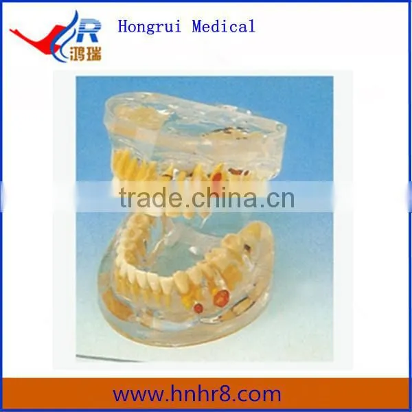 Transparent Teeth Dental Pathology Model