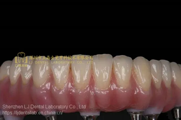 Dental Implant Prosthesis, Implant Denture, Dental Prosthesis, Laboratoire Dentaire, Dentallabor, Laboratorio Dental, Dental Laboratory, Shenzhen LJ Dental Lab China photo-2