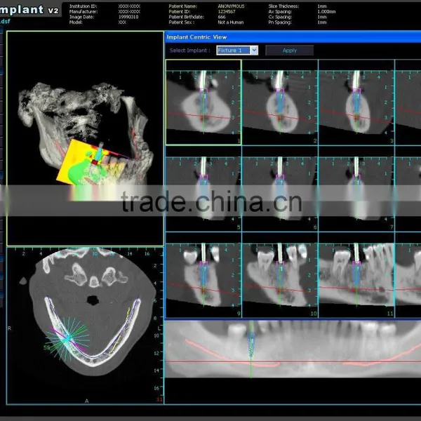 Implant Software - CT