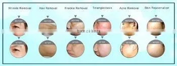 Acne Removal Stationary Ipl Shr Vertical /ipl Shr Machine/ipl Shr For Salon photo-5