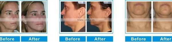 High Intensity Focused Ultrasound High Quality Portable Hifu Laser Machine /laser Hifu Skin Lift Nasolabial Folds Removal photo-6
