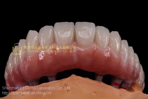 Dental Implant Prosthesis, Implant Denture, Dental Prosthesis, Laboratoire Dentaire, Dentallabor, Laboratorio Dental, Dental Laboratory, Shenzhen LJ Dental Lab China photo-3