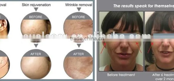 Red Light Therapy For Wrinkles Professional Suslaser PDT Red Led Light Therapy Machine Improve fine lines photo-6
