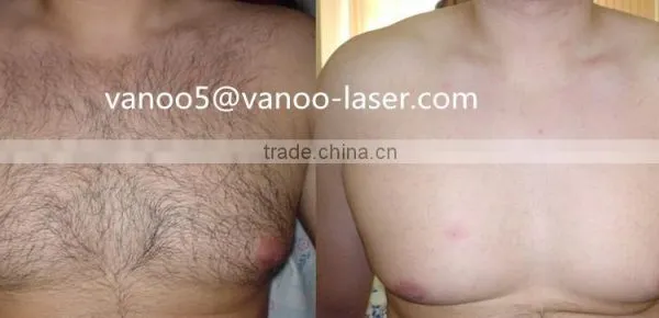 Vascular Treatment 2015 Newest Ipl Skin 10MHz Rejuvenation Machine Home Use Bikini Hair Removal photo-5
