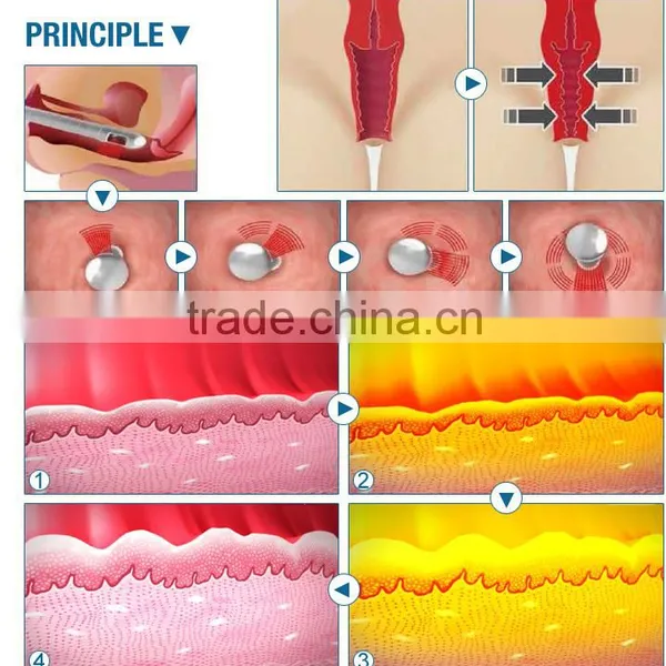 Skin Regeneration Co2 Fractional Rf Birth Mark Removal Vaginal 0.1-2.6mm Tightening Co2 Laser Surgery Machine Tattoo /lip Line Removal photo-6