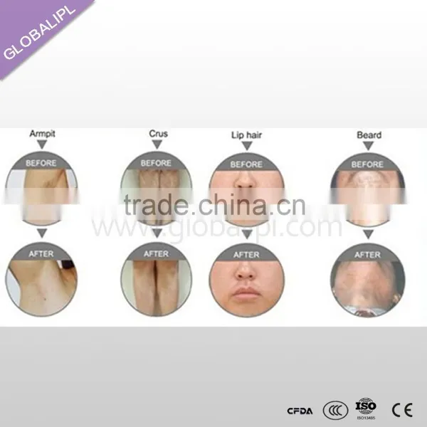 Excellent OEM Professional All Colors Hair Removal Aesthetic Machine photo-6