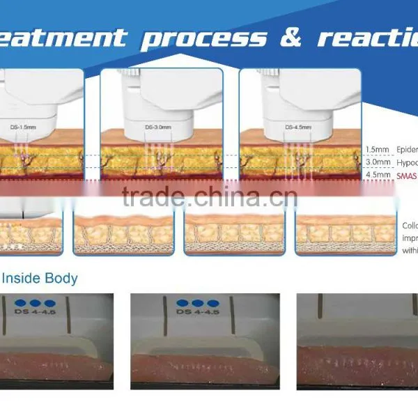 Permanent Face Lift Treatment No Pain Focused Portable Hifu Machine Eye Lines Removal photo-4